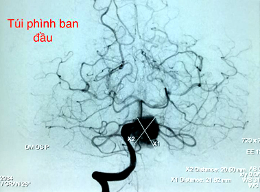 Lần đầu điều trị thành công ca phình mạch máu não không cần gây mê